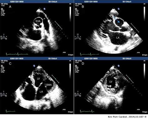 Aneurysm Of The Right Sinus Of Valsalva Dissecting Into The