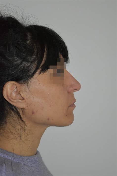 Rhinoplastie Conservatrice Ultrasonique Avant Apr S