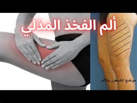 ألم الفخذ المذلي ما هو سبب حرقان الفخذ علاج ألم الفخذ المذلي اهم اسباب