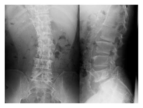 Sagittal Reconstruction Ct Confirming Bilateral Spondylolysis And Download Scientific Diagram