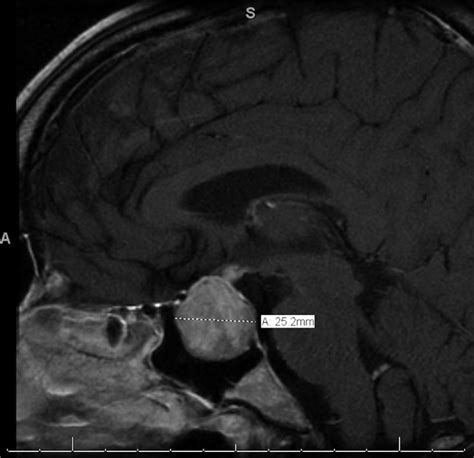 Initial Mri Sagittal View Showing The Pituitary Mass Dotted Line