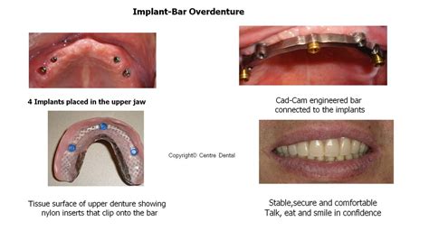 implant retained and supported denture