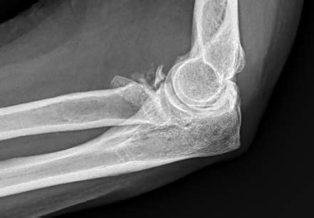 Radial Head Fracture — Joseph J. Schreiber, MD