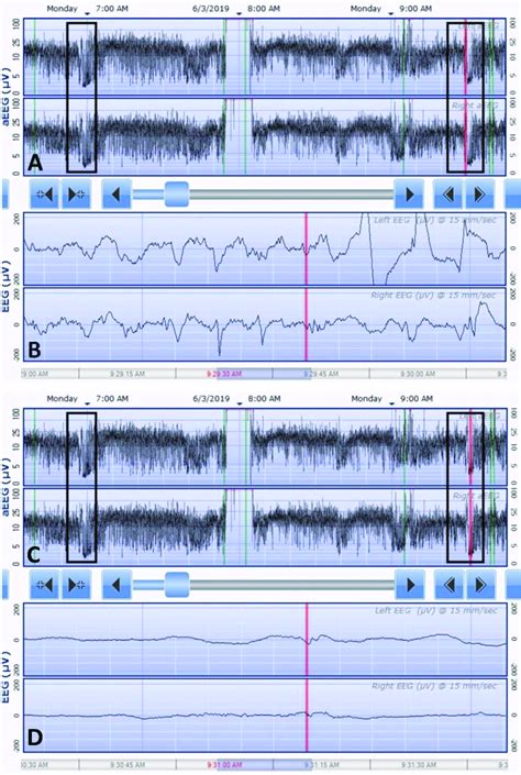 Seizure Pattern Of The Patient With KCNQ2 Encephalopathy On