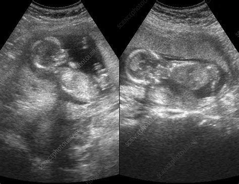 Twin Foetuses Ultrasound Scan Stock Image C003 4226 Science