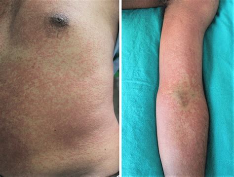 Morbilliform Rash Was The Commonest Presentation Of Rash Download