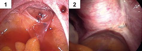 Endometriose IPGO