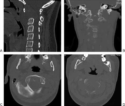 Computed Tomography Ct Scan Of The C2 Axis Showing The Destructive