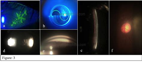 Slit-lamp Biomicroscopy