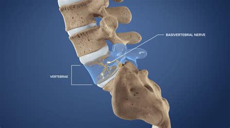 Intracept Procedure For Low Back Pain Advanced Spine And Pain Clinic