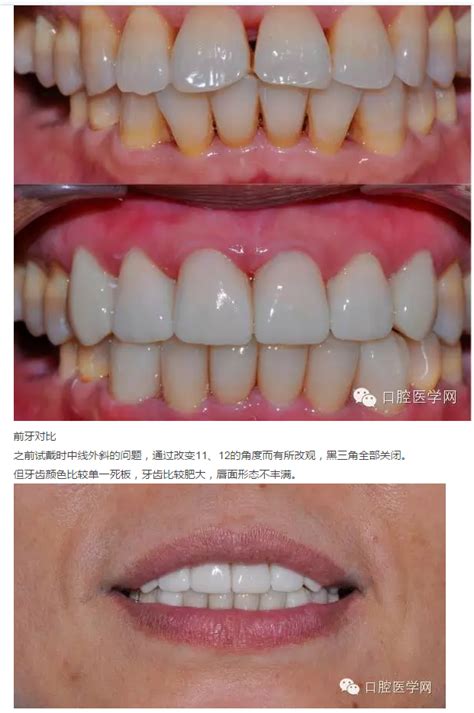 瓷睿刻前牙美学修复1例美学修复陕西嘉友科贸有限公司