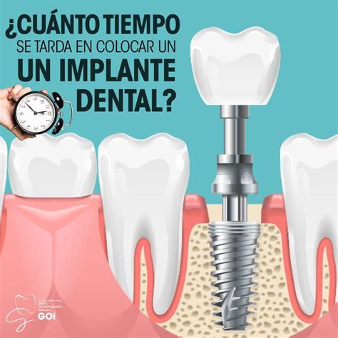 Cu Nto Tiempo Se Tarda En Colocar Un Implante Dental Implantes