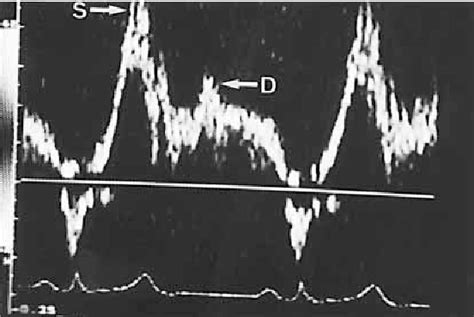 Figure 1 From Transesophageal Doppler Echocardiographic Pattern Of