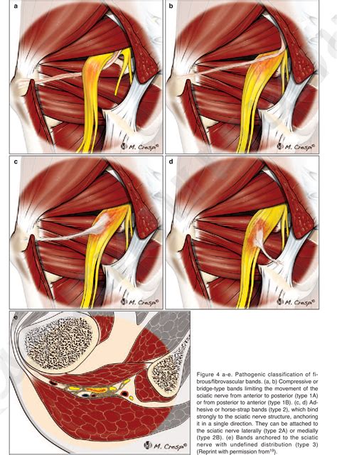 Figure 4 From Deep Gluteal Space Problems Piriformis Syndrome