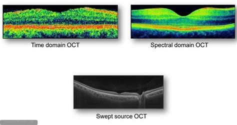 Introduction To Oct Flashcards Quizlet