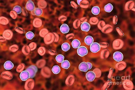 Acute Lymphoblastic Leukaemia Smear Photograph By Kateryna Kon Science