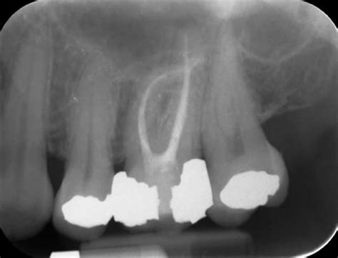 Treatment Cases The Endodontics Centre Maidenhead