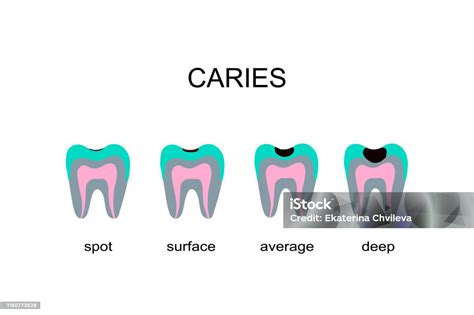 Caries Klasifikasi Spor Permukaan Ratarata Rongga Dalam Tangan Digambar