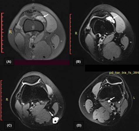 Synovial Hemangioma A Rare Cause Of Chronic Knee Pain Slouma 2022