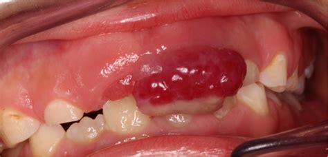 Peripheral Giant Cell Granuloma Vs Pyogenic Granuloma