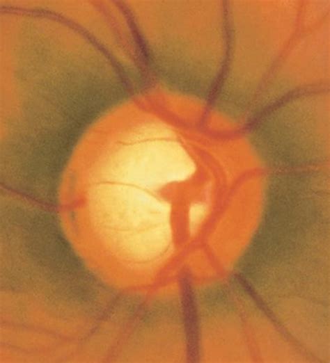 Glaucoma Nursing Article