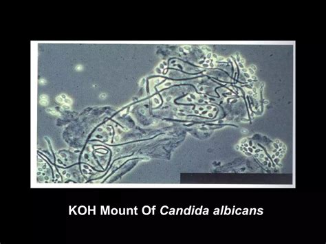 Candidiasis Or Candidosis Ppt