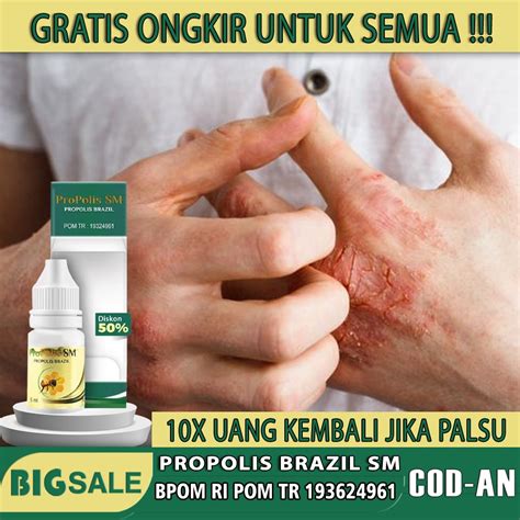 Jual Cara Menghilangkan Bekas Eksim Basah Exsim Kering Menahun Obat