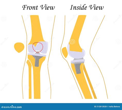 Knee Replacement Joint Prosthetics Knee Endoprosthesis Vector