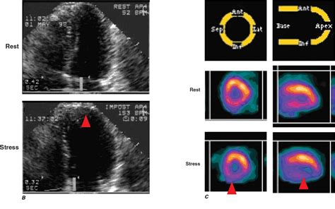 Ischemic Heart Disease Thoracic Key