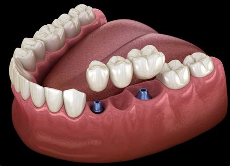 How Bridges And Dentures Perform With Dental Implants Santa Rosa Ca