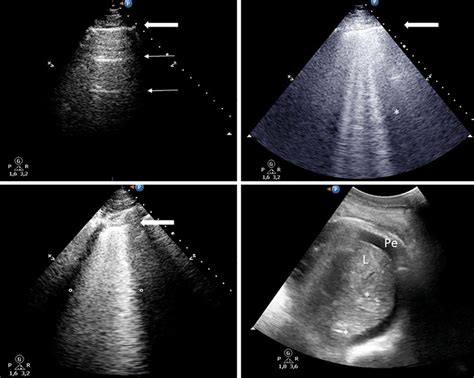 Lung Ultrasound Score Patterns A Normal Pattern The Pleural Line