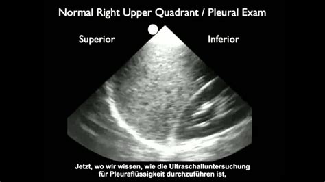 Anleitung: Ultraschallerkennung von Pleuraflüssigkeit - YouTube