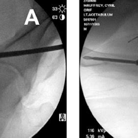 Cannulated Screw In Position On The Obturator Oblique A And The Inlet