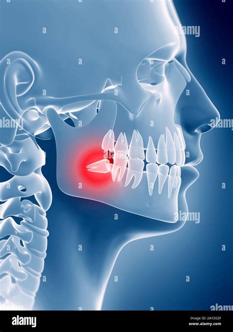 3d Rendered Illustration Of An Impacted Wisdom Tooth Stock Photo Alamy