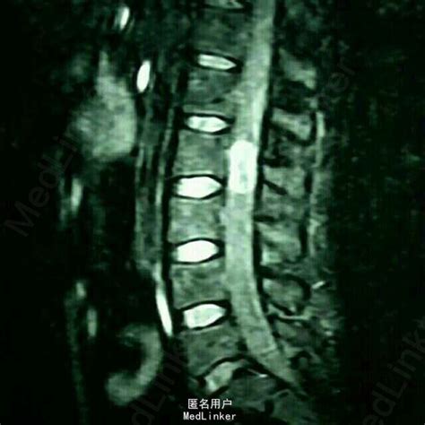 腰2椎管内神经鞘瘤1例 医联