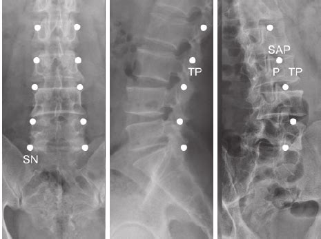 Lumbar Medial Branch Nerve Block