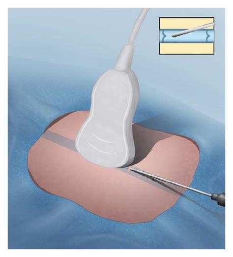 Illustration Of Ultrasound Guided Venous Access A Illustration Download Scientific Diagram