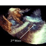 Transesophageal Echocardiogram Four Chamber View With Focus On Right