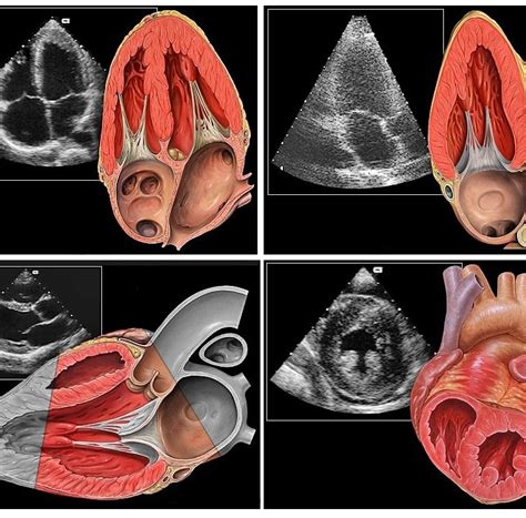 Focused Cardiac Ultrasound Focus Sifultras 542 Sifsof