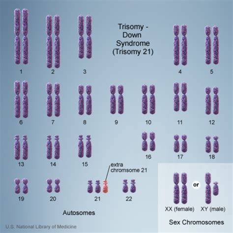 Down syndrome: MedlinePlus Genetics