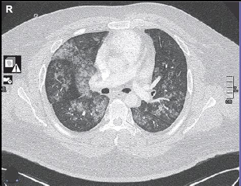 Diffuse Alveolar Hemorrhage Year Old Male With Dyspnea And