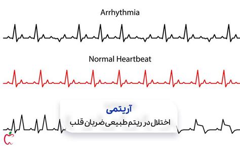 آریتمی قلبی چیست؟5 نوع آریتمی قلبی+13علل ایجاد اریتمی ♥سیوطب