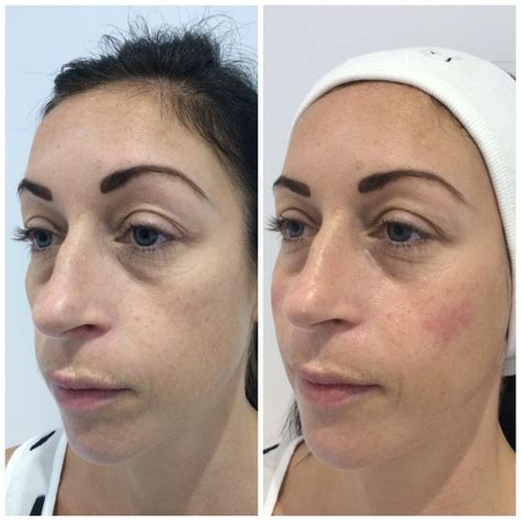 Loss Of Volume True You Skin Clinics