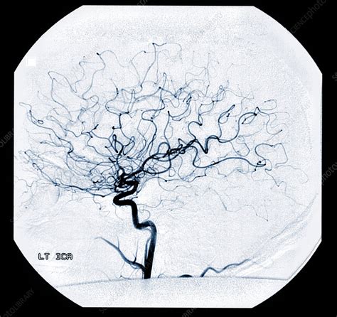 Left Internal Carotid Artery Angiogram Stock Image C