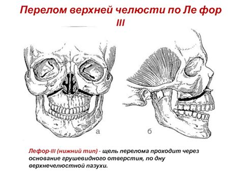 Тема Перелом верхней челюсти Классификация клиника диагностика