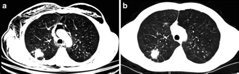 A Year Old Man With Silicosis And Cpod Chronic Pulmonary