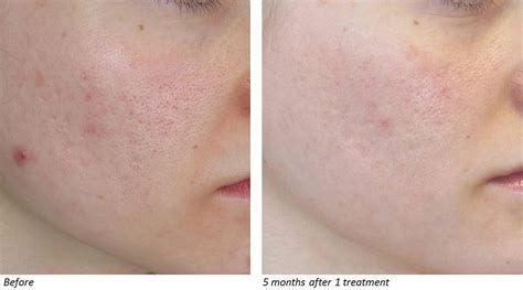 Acne Scar Treatment With Co Laser