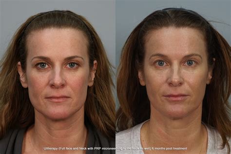 Ultherapy Atlanta | Skin Tightening Greensboro | Roswell, GA