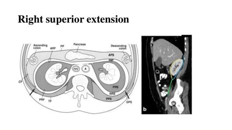 radiological anatomy of retroperitoneum powerpoint