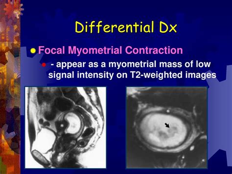 Mohammad A Emam Leiomyoma An Overview By Ppt Download